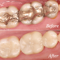 Before and after cosmetic dentistry image 1.