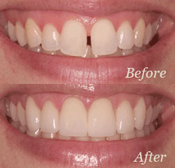 Before and after cosmetic dentistry small image.