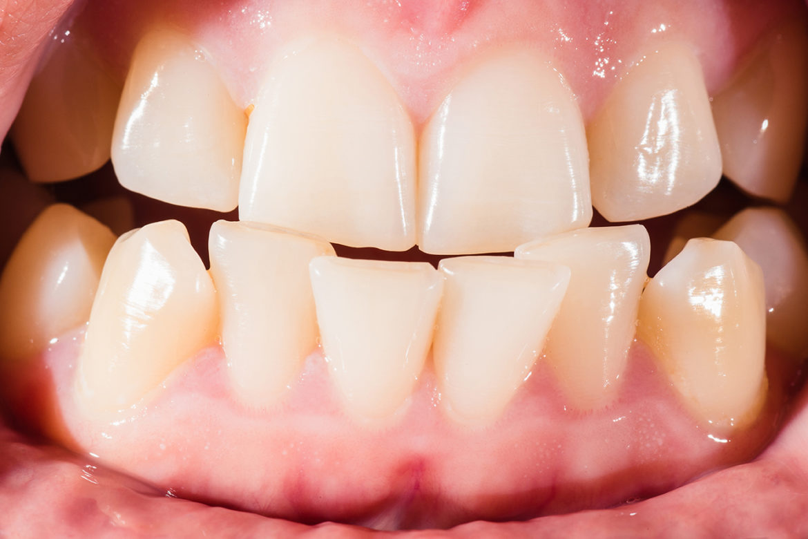 Dentist in Springfield MO Malocclusions Parkcrest