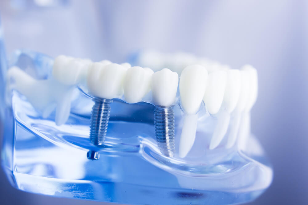 Cosmetic dentistry and the strength of dental implants