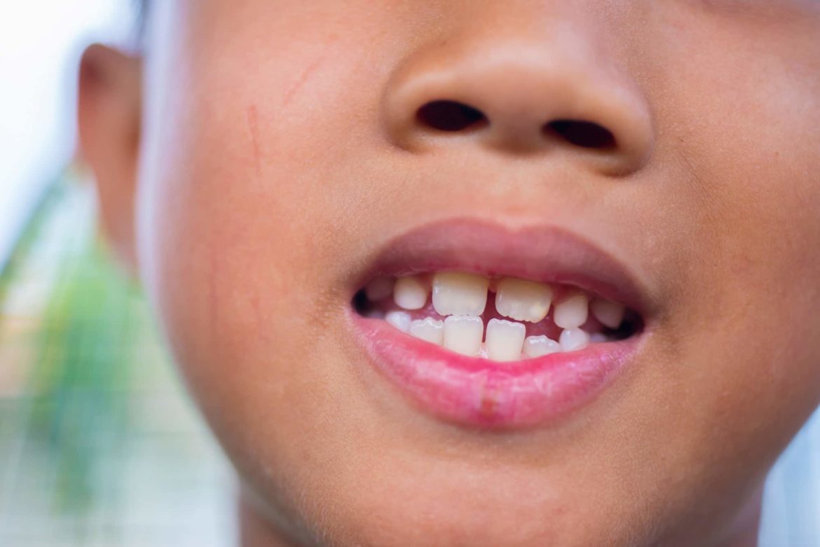 pediatric-dentist-tooth-damage-dr-stuart-scott