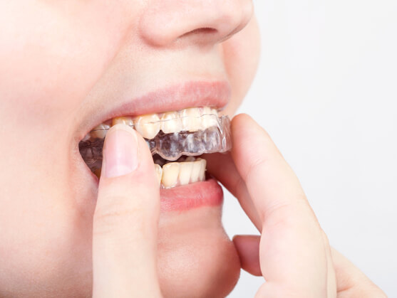 close-up of a woman putting Invisalign on her teeth