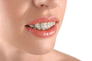Braces on white teeth, white background - orthodontics.
