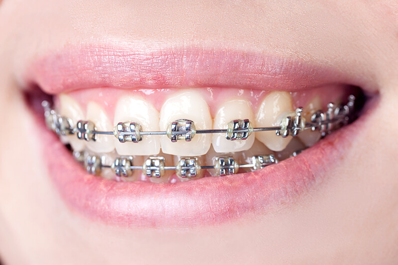 Fixed braces from Dr. Steven Harrison