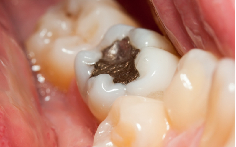 Closeup of a metal dental filling