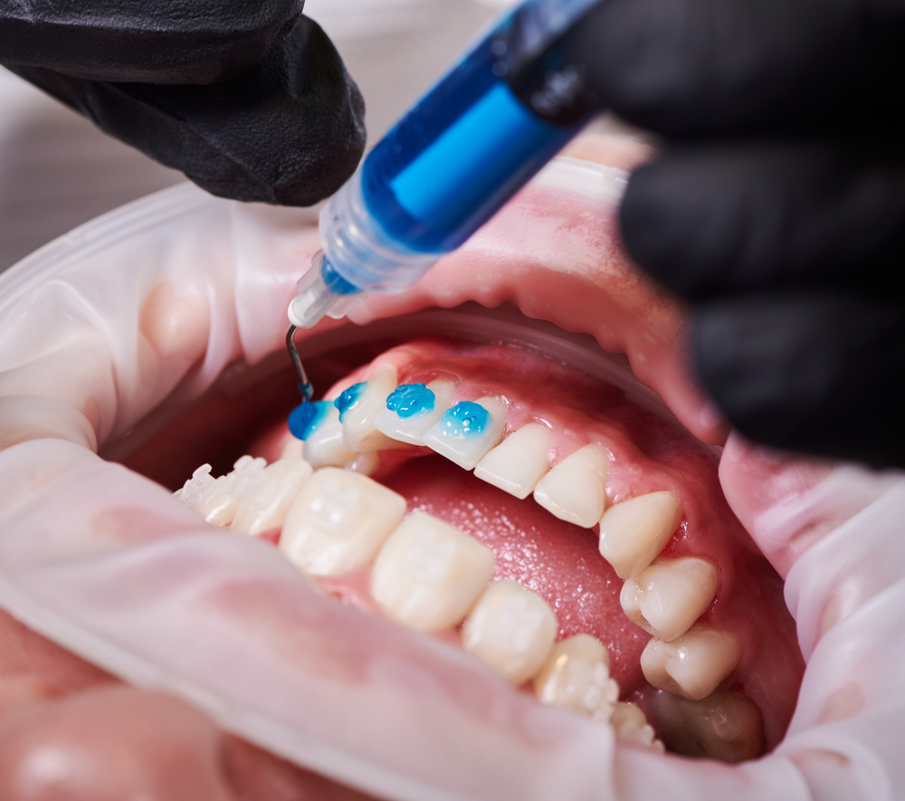 Orthodontist putting ceramic braces on teeth