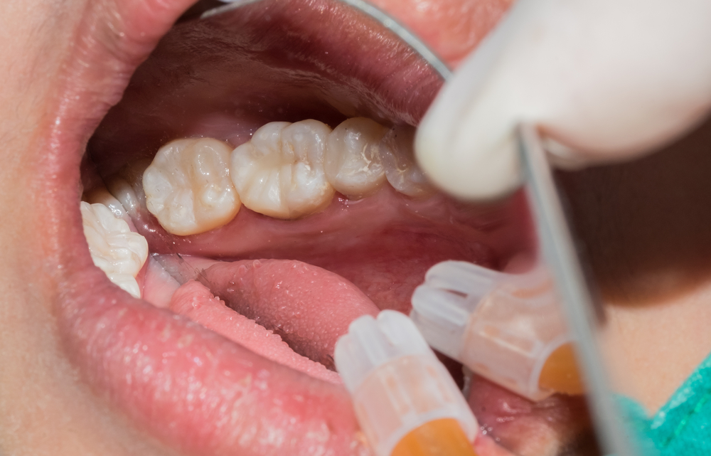 Resin filling on patient's tooth