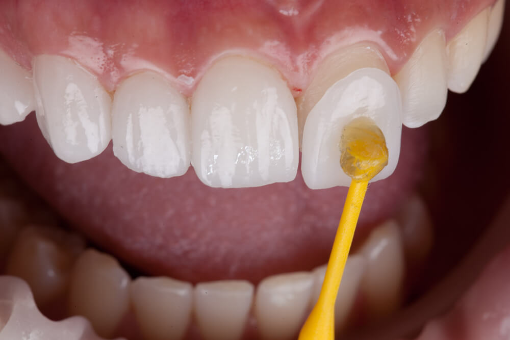 Close Up of Veneer Being Attached to a Tooth
