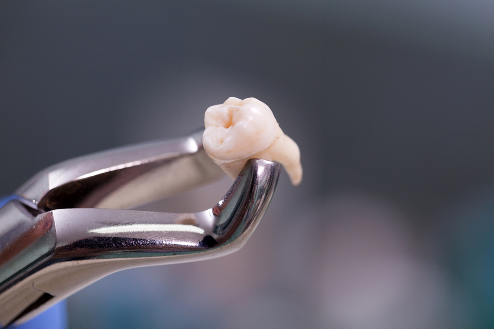 Forceps holding a tooth