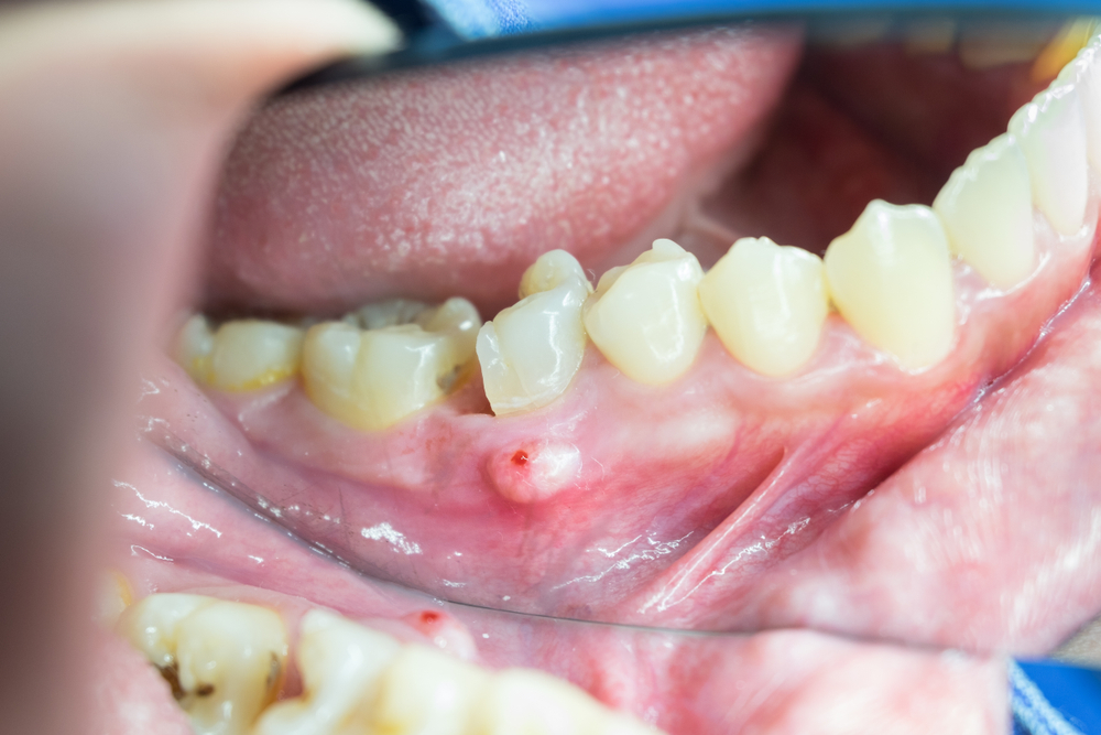 Abscessed tooth showing a sore