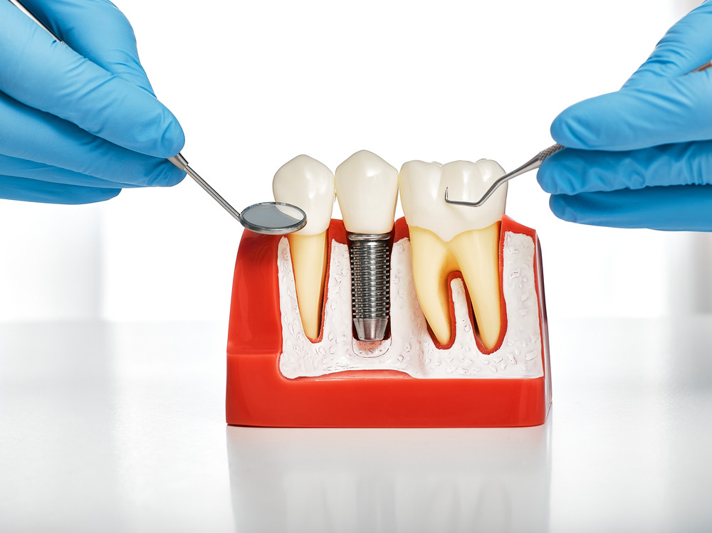 Dentist Looking at Model of Dental Implants