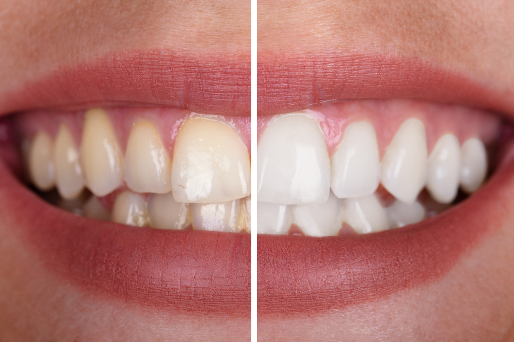 Before and After Calcium Deposits