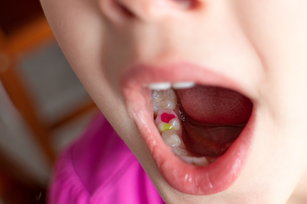 Colorful Tooth Filling in Child's Mouth