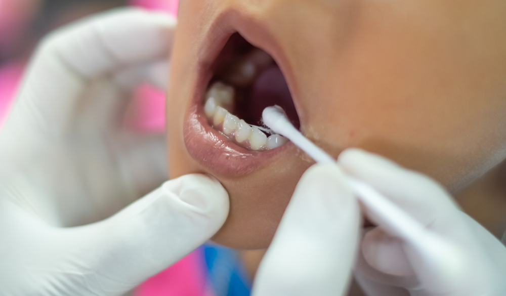 Close-up of a pediatric dental exam with dentist applying treatment to child's teeth using a cotton swab